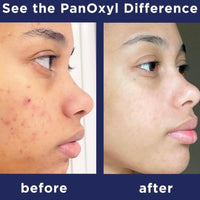 PanOxyl Acne Foaming Wash Benzoyl Peroxide 10% Maximum Strength Antimicrobial, 156g