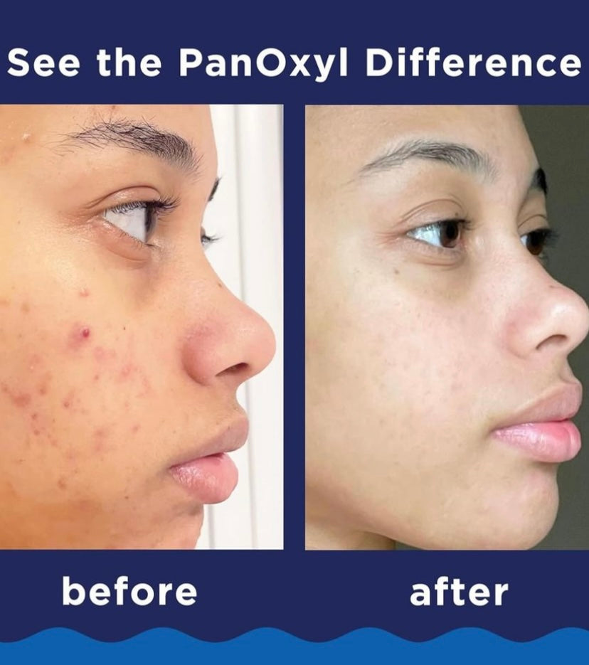 PanOxyl Acne Foaming Wash Benzoyl Peroxide 10% Maximum Strength Antimicrobial, 156g